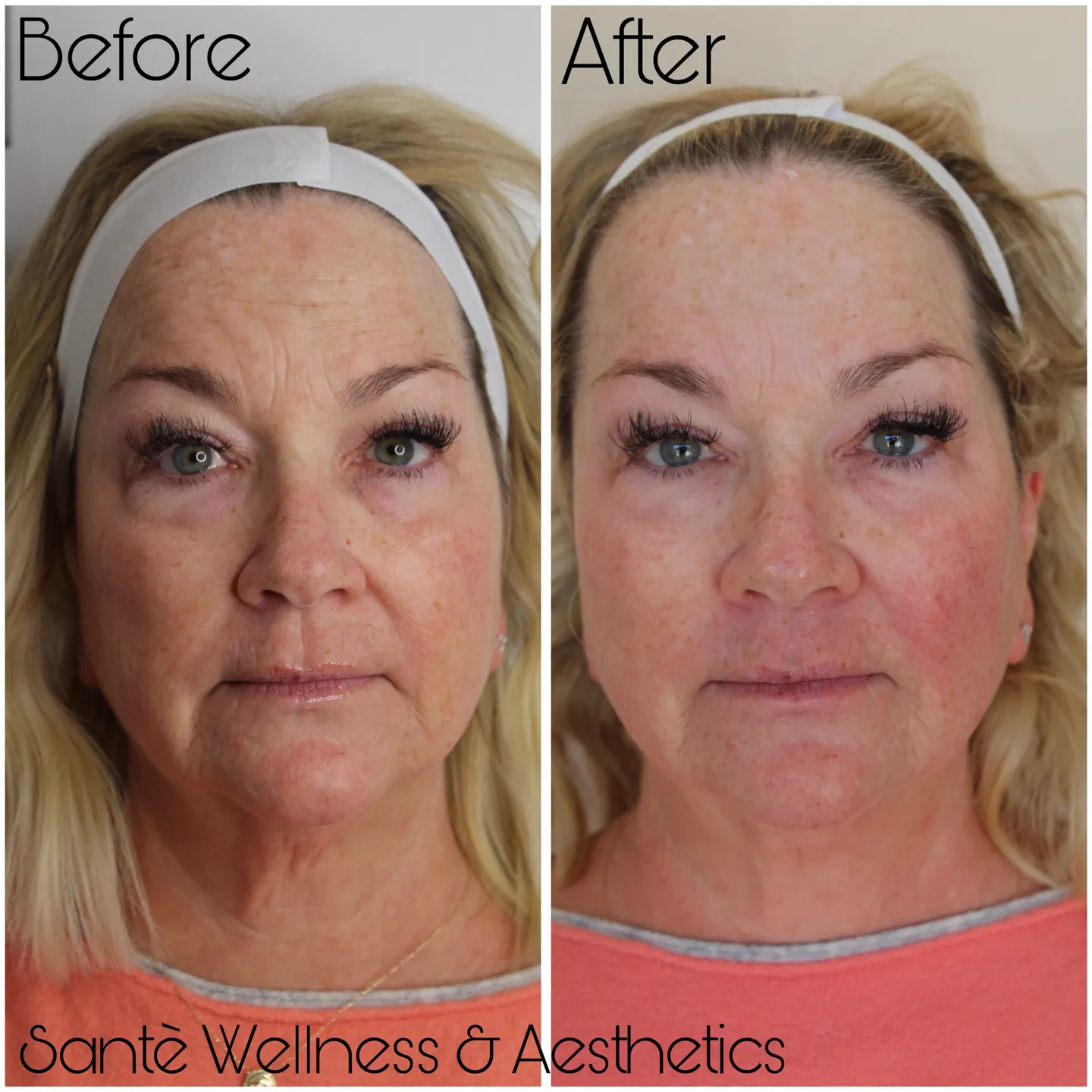Before and after XERF™ treatment — patient showing improved skin firmness, reduced fine lines, and smoother texture